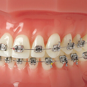 braces / braces