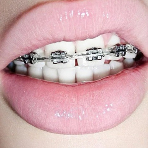 Braces for Milena