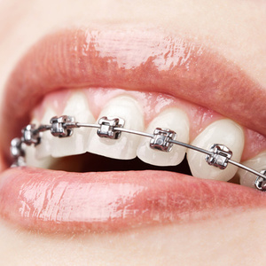 Braces