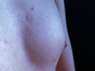 Breast