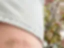 Birthmark