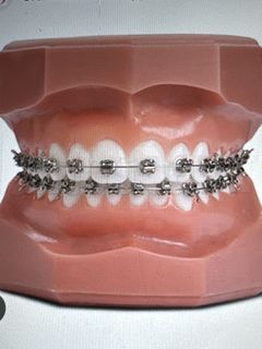 Braces