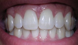 I want teeth