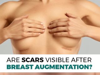 Breast Augmentation
