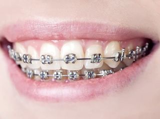 BRACES