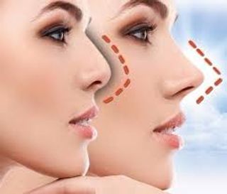 Rhinoplasty