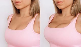 Enlarge breasts