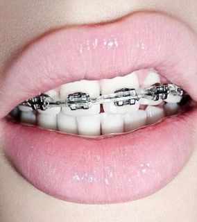 Braces for Milenochka