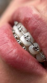 Braces