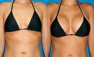 breast augmentation