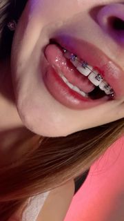 Braces