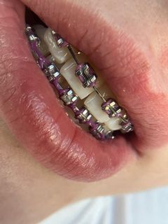 jaw surgery