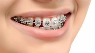 Красивая улыбка (брекеты)