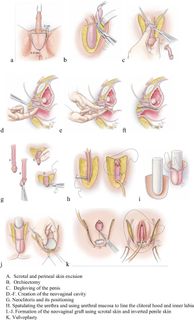 Sex reasigment surgery