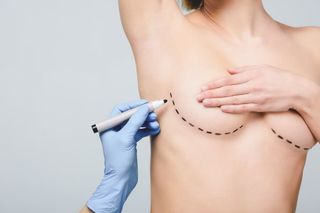 Mammoplasty