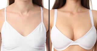 Breast Augmentation