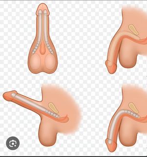 Endophaloprosthetics