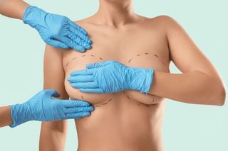 Mammoplasty