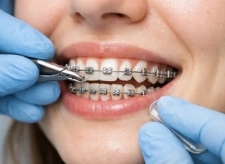 Брекеты