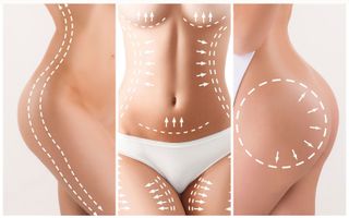 I want my liposculpture