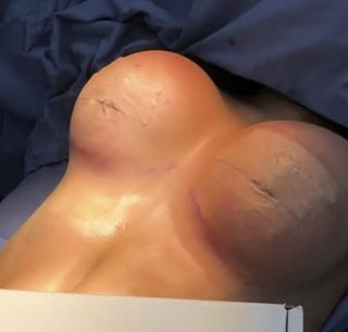 Operate on my breasts??