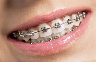 Braces