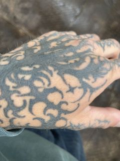 Tattoo removal