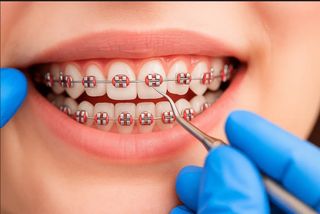 Braces