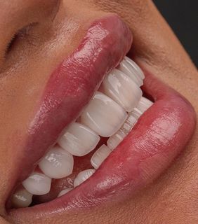Veneers