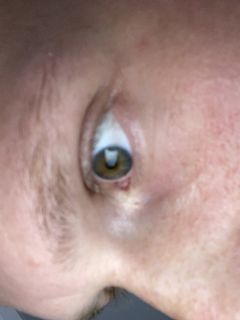 Vision correction