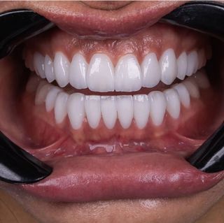 Veneers